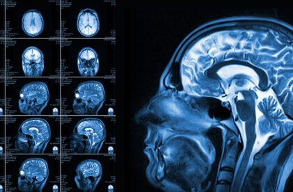 BrainInjury